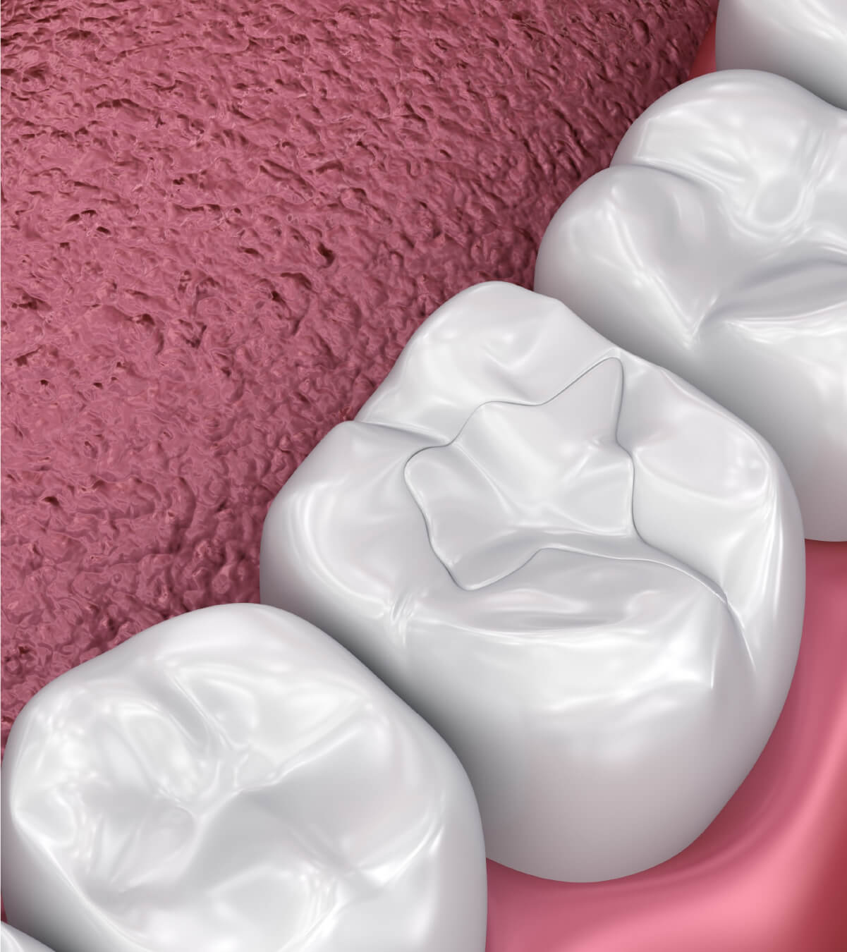 What Are Dental Crowns?